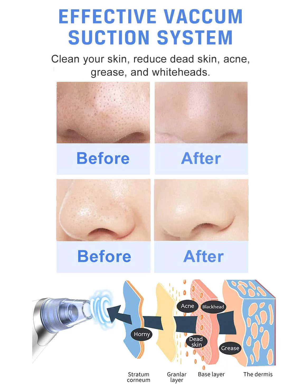 Ansten pore vacuum face cleaner blackhead remover kit blackhead remover pore vacuum suction electric facial pore cleaner usb rechargeable blackhead pimple sucker for nose face women men